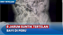 8 Jarum Suntik Ditemukan dalam Perut dan Usus Bayi di Peru