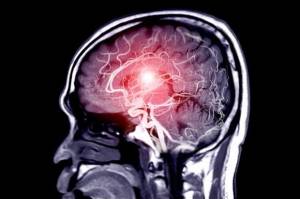 Berkat Teknologi, Aneurisma Otak Kini Bisa Ditangani Tanpa Pembedahan