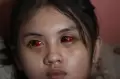 Viral, Penampakan Mata Merah Suporter Cantik Arema Efek Tembakan Gas Air Mata Kedaluwarsa