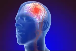 Mengenal Penyakit Aneurisma Otak, Penyebabnya Bisa dari Tekanan Darah Tinggi