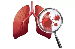 5 Perbedaan Penyakit Pneumonia Biasa vs Mycoplasma Pneumonia